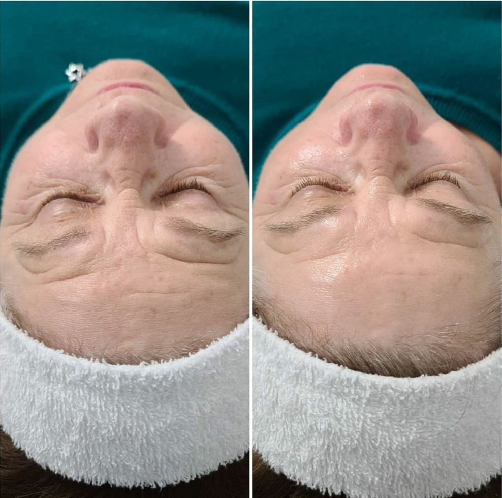 saskatoon facials spa botox dysport injections injectables anti aging frown lines wrinkles acne
