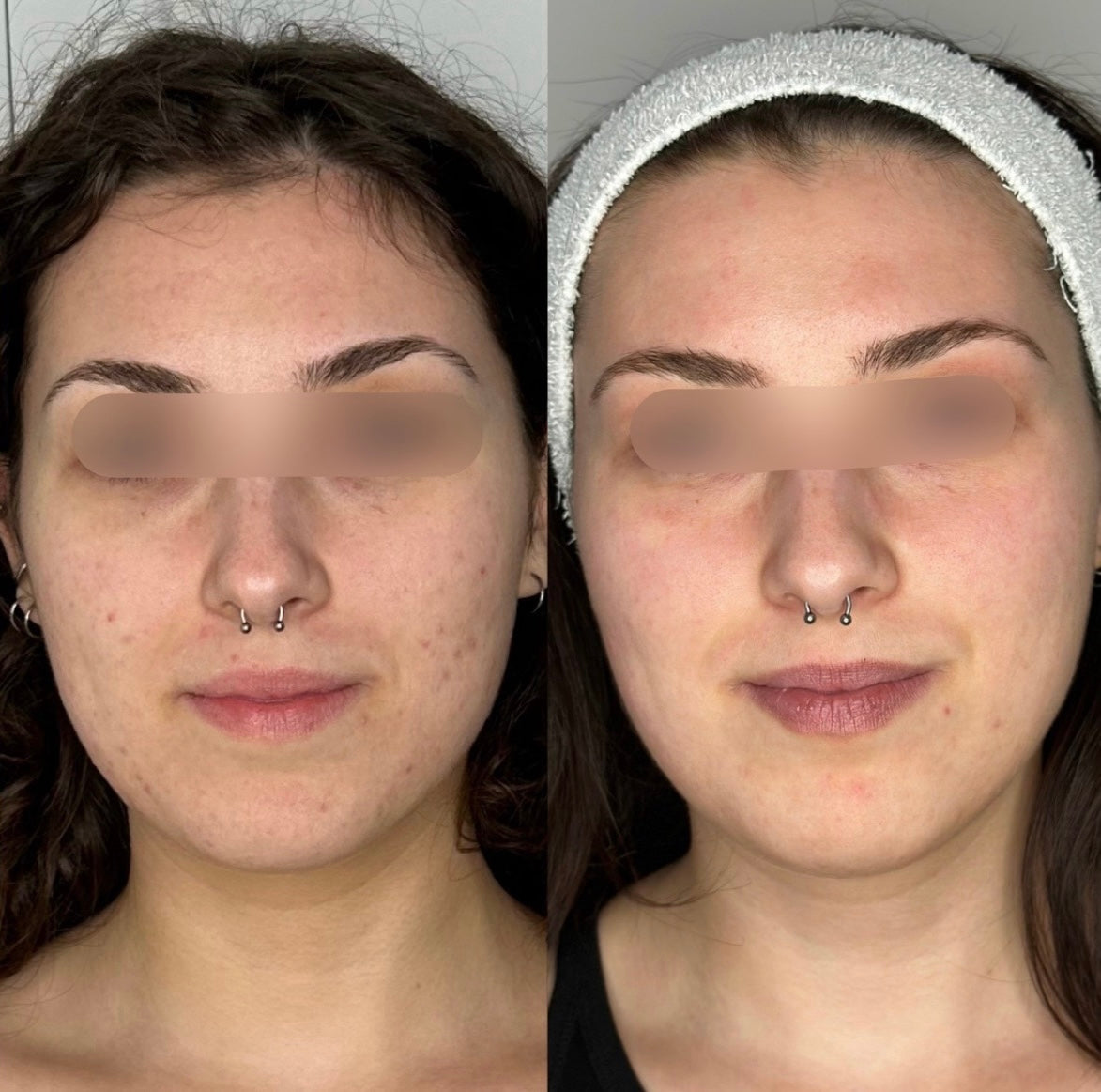 saskatoon facials spa botox dysport injections injectables anti aging frown lines wrinkles acne
