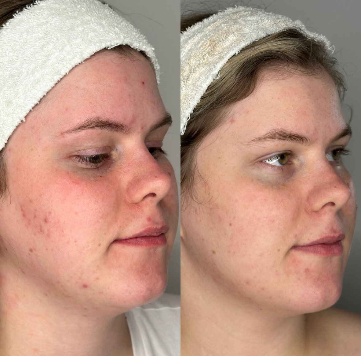 saskatoon microneedling facials spa botox dysport injections injectables anti aging frown lines wrinkles acne