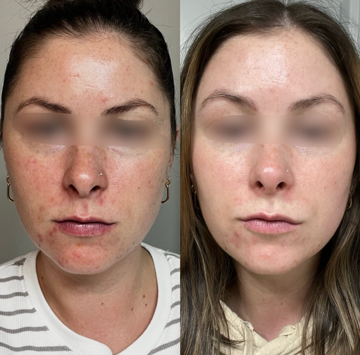 saskatoon microneedling facials spa botox dysport injections injectables anti aging frown lines wrinkles acne